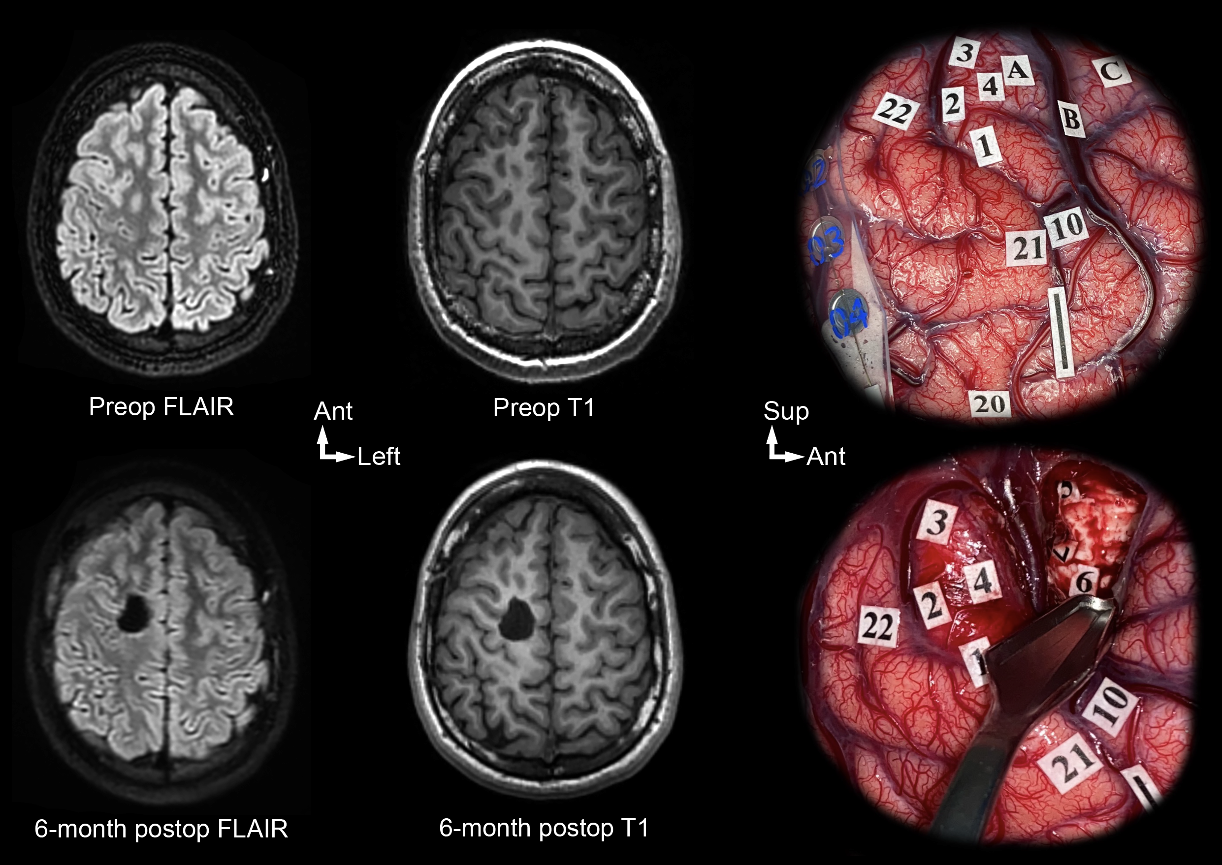 Une image contenant Imagerie médicale, Cerveau, capture d’écran, cercle
Le contenu généré par l’IA peut être incorrect.