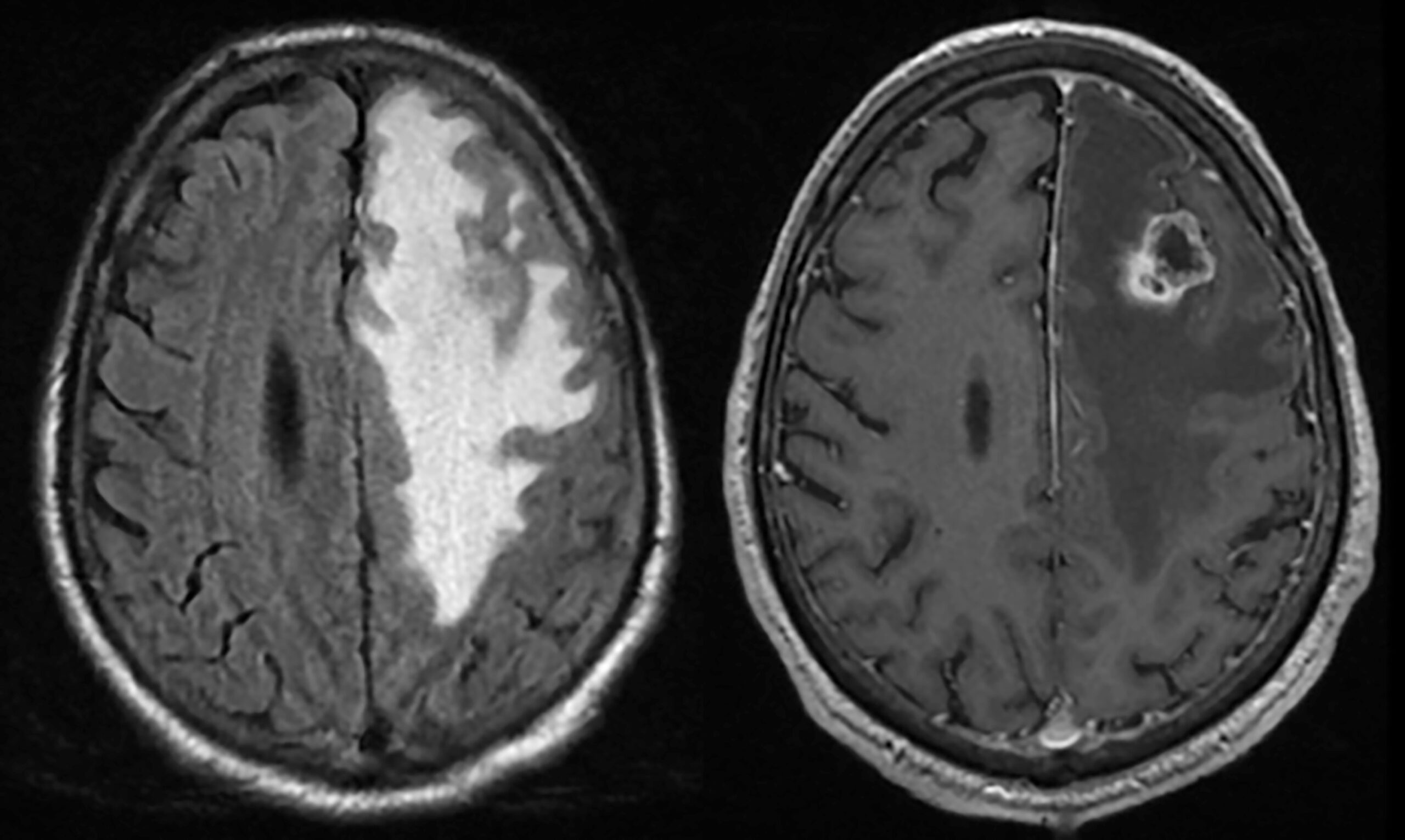 Meta_oedemateuse.jpg