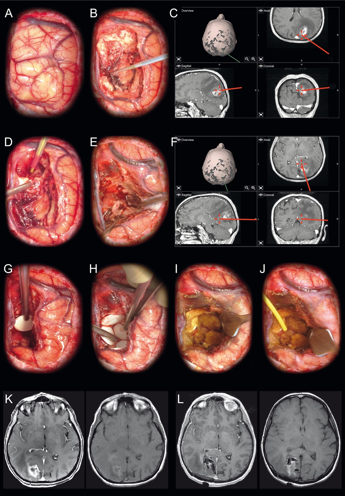 ../Publications/2017/Carmustine-%20Recommandation/Figure%201.jpg